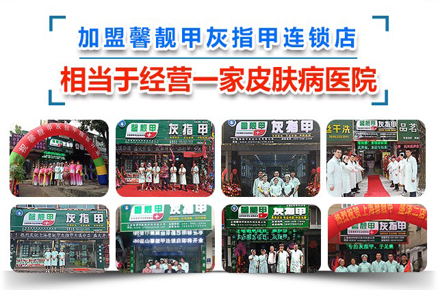 灰指甲招商加盟适合青年人的几大优势