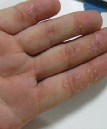 急性湿疹炎症减轻后,皮损以小丘疹,结痂和鳞屑为主,仅见少量丘疱疹及